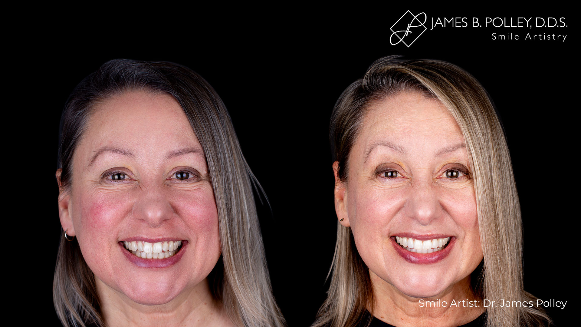 Rene-Roberts---Post-op-Face_3