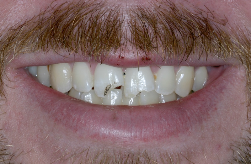 What to Do If You Chip a Tooth Dr. James Polley DDS