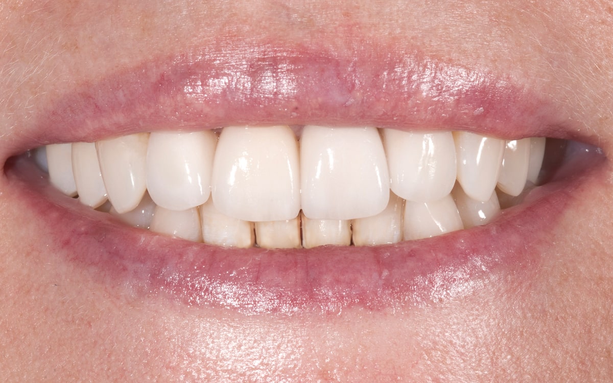 After Dr. Polley was able to craft beautiful all-ceramic crowns for this female patient she felt confident to smile with a healthy, natural look
