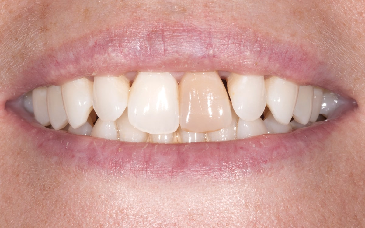 Before consulting with cosmetic dentist Dr. Polley this Summerlin patient didn't want to smile due to her dark front tooth.