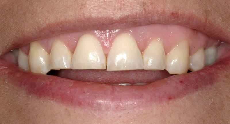 Before meeting Summerlin dentist Dr. James Polley this female patient was conscious about her worn down smile.