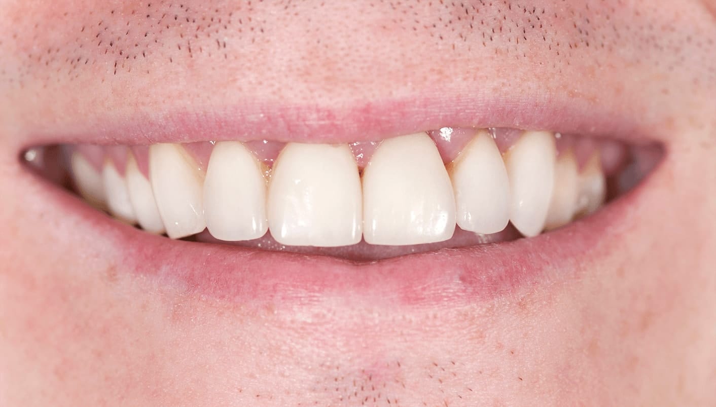 After dental restorations, James B Polley was able to show off his beautiful smile.