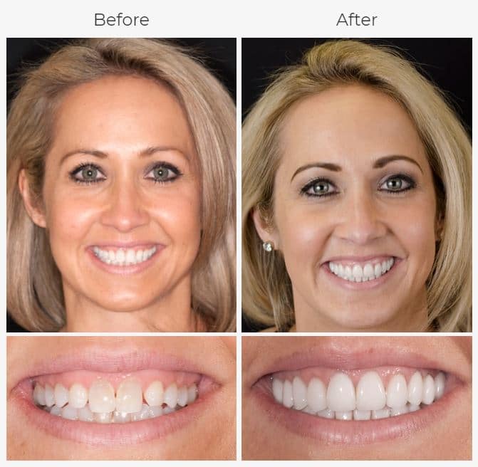 How Long Does a Smile Makeover Take | Cosmetic Dentist Las Vegas