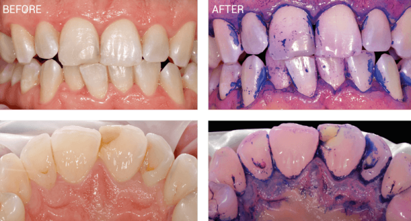 Biofilm Therapy Before And After